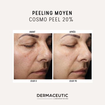 Peeling médical